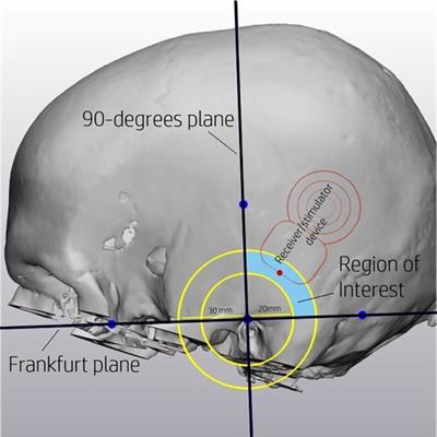 Cochlear implant positioning: development and validation of an automatic method using computed tomography image analysis